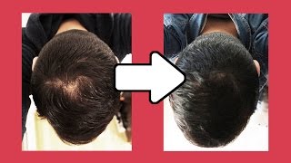 CALVITIE  Le MINOXIDIL contre la chute de cheveux Alostil 5 [upl. by Asilram828]