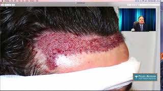 Hairline Transplant How We Did It Feller and Bloxham  Great Neck  NY  NJ  CT [upl. by Noryv]