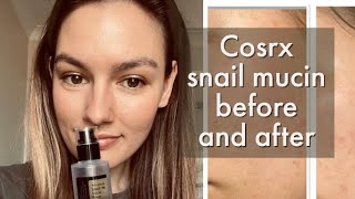 Cosrx snail 96 mucin 1 month review Before and after [upl. by Silsbye]