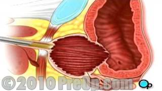 PreOp® Patient Ed TURP Transurethral Resection Prostate of the Penis [upl. by Xam]