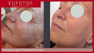 Fractional Laser Treatment for Face Non Ablative Rejuvenation Eufoton [upl. by Aihsiek]