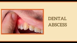 Understanding Dental Abscess Causes Symptoms and Treatment shorts youtubeshorts [upl. by Clements70]