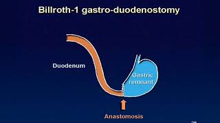 01 Billroth 1 reconstruction animation [upl. by Aneba]