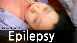 Treatment case of epilepsy  간질 뇌전증 치료사례 [upl. by Xever]