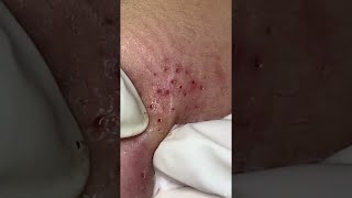 Big Cystic Acne Blackheads Extraction Blackheads amp Milia Whiteheads Removal Pimple Popping shorts [upl. by Katleen]