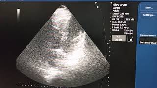 Dextrocardia Situs Viscerum Inversus [upl. by Biondo528]