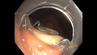 Full Thickness Resection of Appendiceal Orifice using Ovesco FTRD [upl. by Nivloc648]