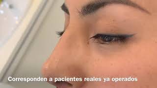 Postoperatorio de rinoplastia ultrasónica a los 7 días [upl. by Ecitnerp]