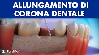 Corona dentale  Allungamento di corona clinica © [upl. by Telfore]