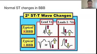 Bundle Branch Blocks [upl. by Leifer184]