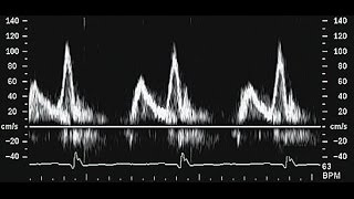 Medical Index  Diastolic Heart Failure What is it [upl. by Havot227]