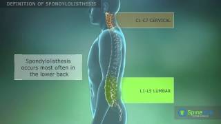 Spondylolisthesis Definition [upl. by Ccasi]