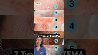 7 Eczema Types How to Tell Which One You Have [upl. by Nollat]