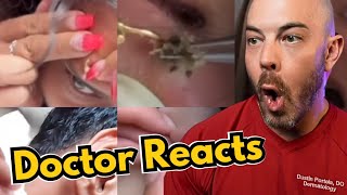 Dermatologists Reaction to Viral Pimple Popping Cyst Popping TikToks [upl. by Sihtam]