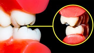 Comment Arrêter de Grincer Des Dents la Nuit [upl. by Gloriane]