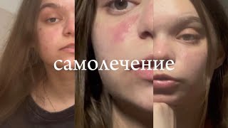 Пытаюсь лечить себя сама ОКРDermatillomania Дерматилломания [upl. by Schell]