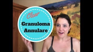 How my Granuloma Annulare Cleared Up [upl. by Durston]