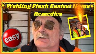 Welding Flash Easiest Home Remedies [upl. by Aneekahs28]