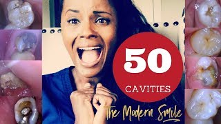 50 Cavities photos with treatment narrated by dentist [upl. by Argus]