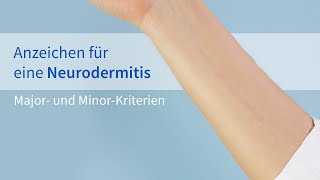 Anzeichen für eine Neurodermitis  Major und Minorkriterien │Dr med Alice Martin [upl. by Kellie506]