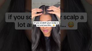 what you see it’s not dandruff 🦠  hair growth tips youtubeshort hair hairgrowth [upl. by Farah]