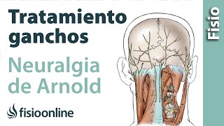 Tratamiento de fisioterapia con ganchos para la neuralgia de Arnold o neuralgia occipital [upl. by Yrolam]