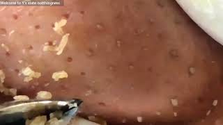 No misses Video of tweezers used to remove blackheads that leave craterlike holes 3時間ピンセット角栓取り動画 [upl. by Etolas]