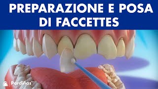 Faccette dentali  Preparazione e posa di faccettes © [upl. by Holcman]