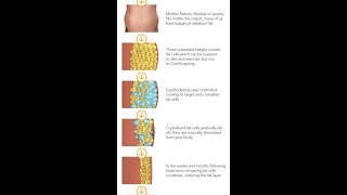 Coolsculpting vs Liposuction [upl. by Enenaej16]