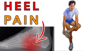 Heel Pain Solutions  Revolutionary Treatment  Dr Michael Horwitz [upl. by Curr]