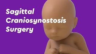 Sagittal Craniosynostosis Surgery [upl. by Arodoet]