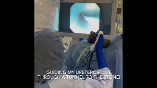 Ureteroscopy with Laser Lithotripsy  Treating Kidney Stones  Real Procedure Footage [upl. by Tiffie]