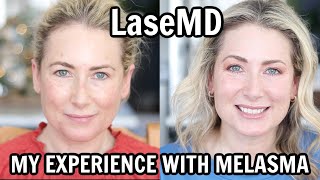 LaseMD  My Experience Treating Melasma with Lasers  MsGoldgirl [upl. by Tarrsus]