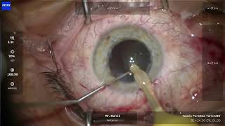 PureSee Toric IOL Implantation [upl. by Mcneely]