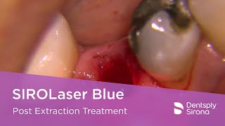 SIROLaser Blue  Post Extraction Treatment [upl. by Ahsiekel]