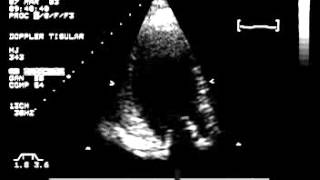 Video 14 Doppler Tisular [upl. by Deegan]