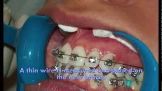 How braces are put on teeth 2012 [upl. by Eldoree]