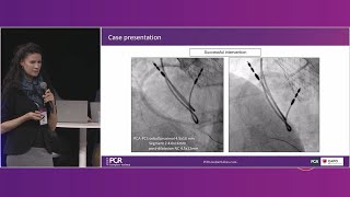 TAVI and beyond tackling coronary challenges  PCR London Valves 2023 [upl. by Ylrebmit]