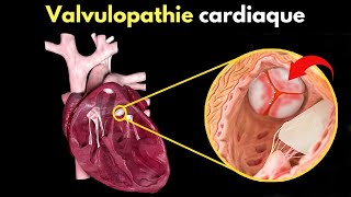 Comment se produit la valvulopathie cardiaque  Symptômes diagnostic et traitement [upl. by Zelazny]