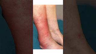 How to Treat Cellulitis mumbai shortsfeed2024 vascularhealth shortsvideo [upl. by Alyehc]