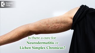 What is Neurodermatitis Causes Symptoms Diagnosis Treatment  Dr Aruna Prasad [upl. by Cristionna350]