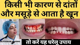 दांतो और मसूड़े से खून आना घर पे ही कैसे रोके  How To Stop Bleeding Gums At Home  Gingivitis [upl. by Ahsoet]