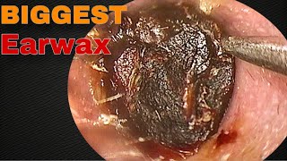 BIGGEST Earwax Difficult Removal EP 10  Doctor Anh [upl. by Marteena415]