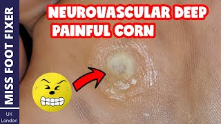 Neurovascular DEEP PAINFUL Corn Removal  Full Thickness Corn  BY MISS FOOT FIXER [upl. by Ytissac]