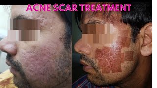 Laser acne scar removal  Before and after results  Laser treatment for scars [upl. by Natanoy614]