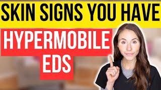 Unlocking The Secrets 12 Surprising Skin Signs Of Hypermobile EhlersDanlos Syndrome [upl. by Yorgerg910]