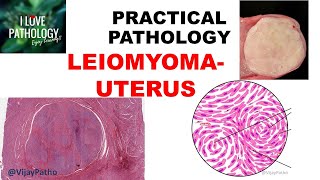 LEIOMYOMA UTERUS etiology Clinical features Gross amp Microscopy [upl. by Sotsirhc92]