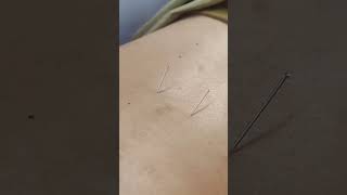 dry needling therapy video ytshorts physio protocol utubeshorts [upl. by Power]