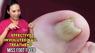 Effective Involuted Nail TreatmentGet Relief and Healthy Nails By Famous Podiatrist Miss Foot Fixer [upl. by Keyte]