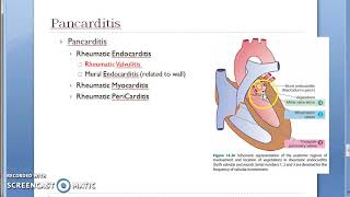 Pathology 436 d Rheumatic Fever Heart Disease Endocarditis Valvulitis Mitral valve Fish mouth button [upl. by Llenrod]